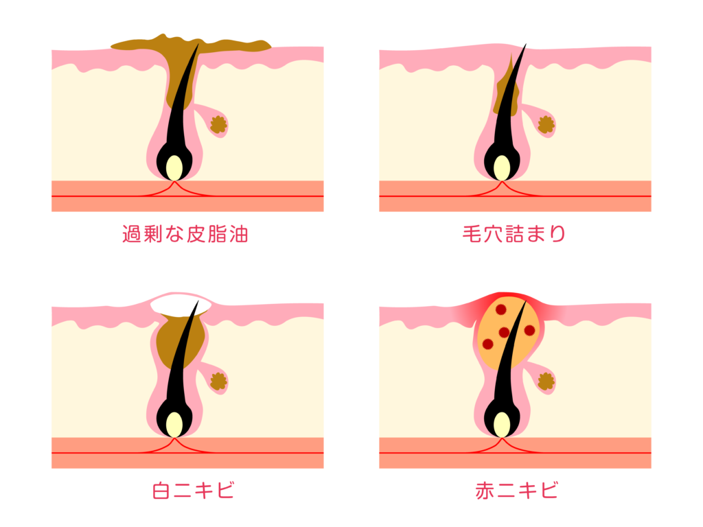 コメド・ニキビ・角栓の違い