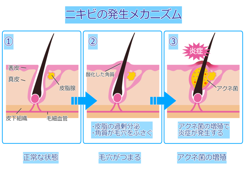 炎症を起こしているニキビ